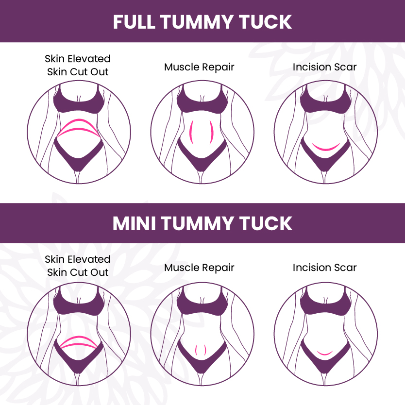 Full Tummy Tuck vs Mini Tummy Tuck Infographic