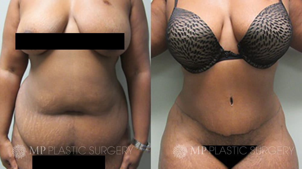 Choosing A Tummy Tuck After Pregnancy, Reversing The Physical