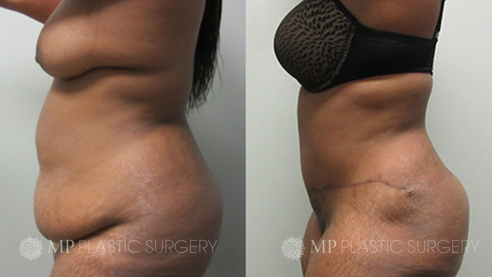 Abdominoplastia - Vegas Liposuction