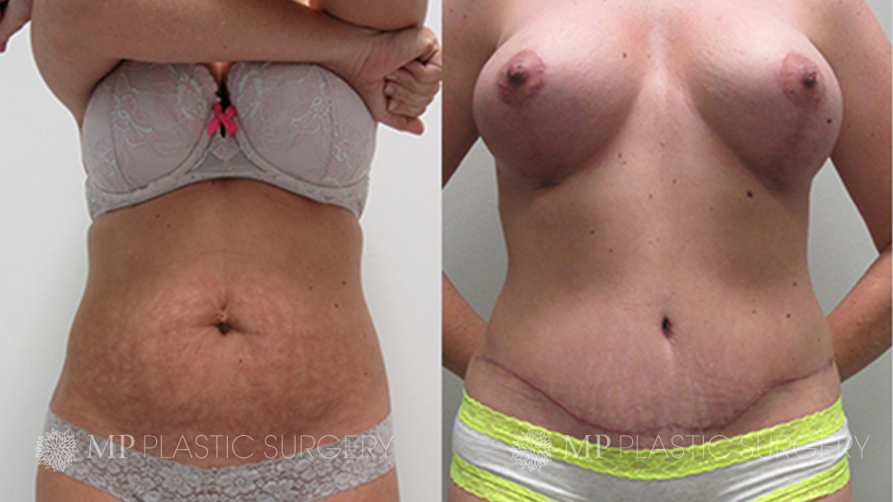 Tummy Tuck - Corrective/Revision Before and After Results