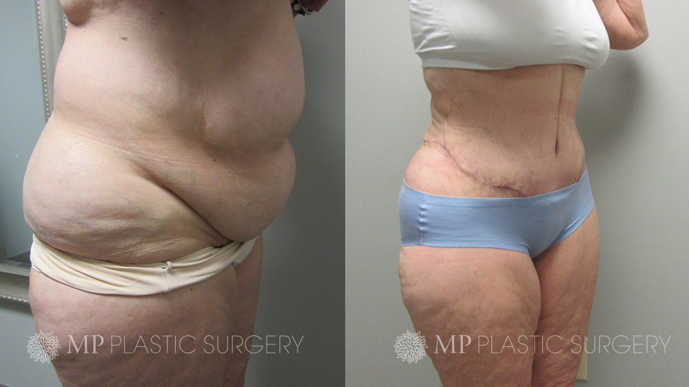 Tummy Tuck 3 Week Update  Before and After Pictures & Full Experience! 