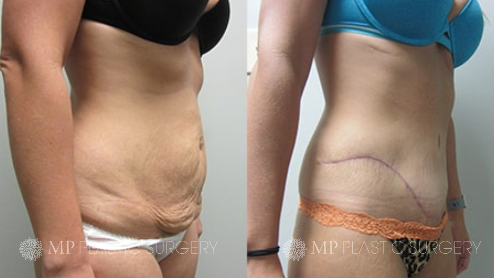OR Snapshots - Abdominal and Flank Liposuction - Explore Plastic Surgery